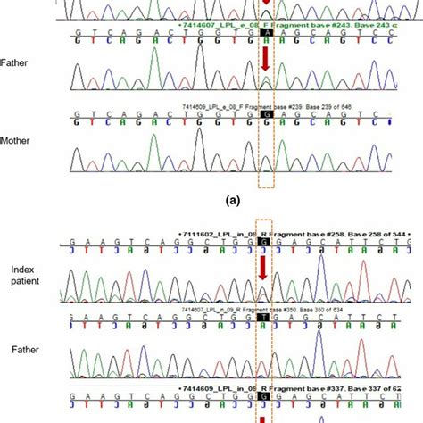 Sanger Sequencing Chromatograms Partial Dna Sequences In The Lpl Gene