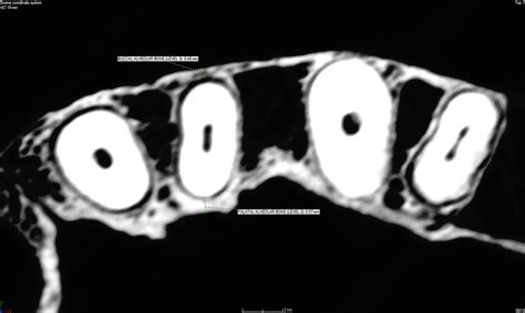 Buccal And Palatal Alveolar Bone Dimensions In The Anterior Maxilla A