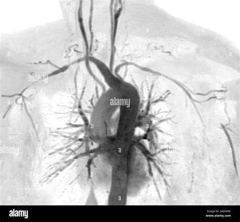 Takayasu S Arteritis Magnetic Resonance Imaging Mri Scan And