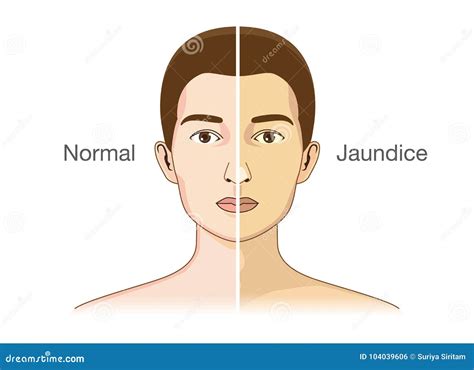 The Comparison Between Normal Skin People And Yellowing From Jaundice Stock Vector