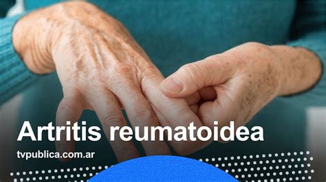 Qu Es La Artritis Reumatoidea Y C Mo Detectarla En Casa Salud