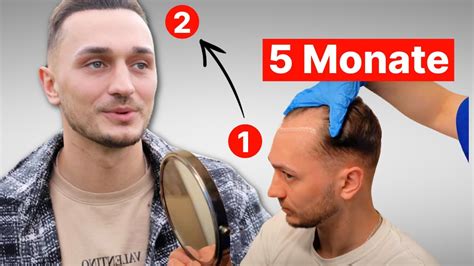 Rudis Haartransplantation Nach 5 Monaten Erfahrung YouTube