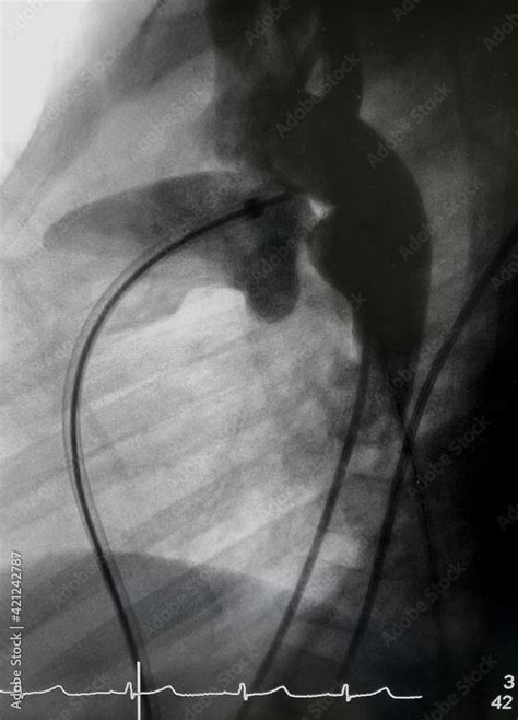 Aortography showed patent ductus arteriosus (PDA) during PDA closure ...