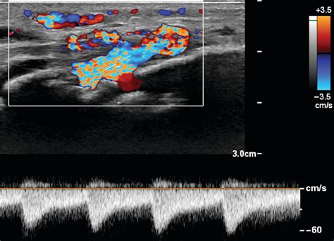 Ultrasound Evaluation Of Pediatric Slow Flow Vascular Malformations Practical Diagnostic