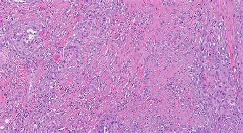 Mypathologyreport Ca