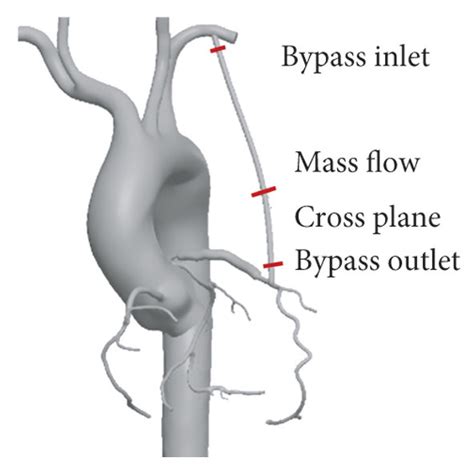 The Osi Distribution On The Bypass Grafts Svg And Lima In A Cardiac Download Scientific