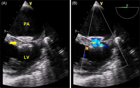 Six‐month Follow‐up Transesophageal Echocardiography A Yellow Arrow Download Scientific