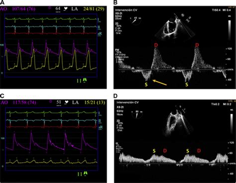 Massive Primary Mitral Regurgitation Due To Chordae Rupture Treatment