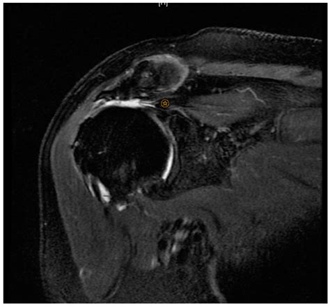 Ijerph Free Full Text Massive Irreparable Rotator Cuff Tears Which Patients Will Benefit