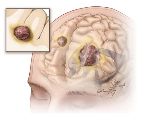 Metástase No Cérebro - Metástase Cerebral Tratamento Porto Alegre Neurocirurgia CEANNE
