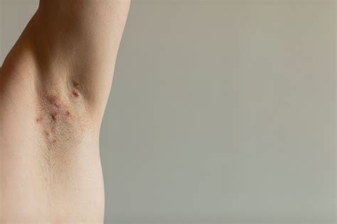 Hidradenitis Suppurativa: Symptoms, Causes, and Treatments