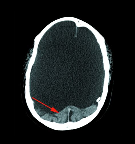 Hydranencephaly Ultrasound