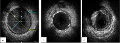 Intravascular Ultrasound Derived Minimal Luminal Area And Plaque Burden