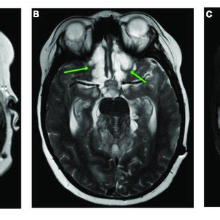 | CNS MRI of the patient after 5.5 months of the debut of the disease.... | Download Scientific ...