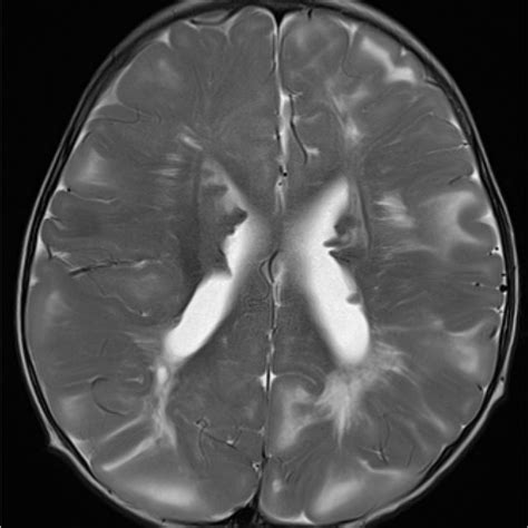 MRI brain axial T2 sequence demonstrates the typical findings of ...