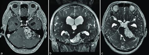 Preoperative Axial T1 Weighted Enhanced Magnetic Resonance Imaging