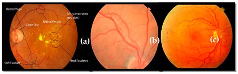 Hypertensive Retinopathy Symptoms