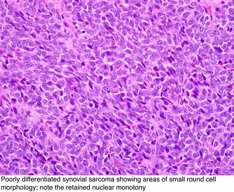 Pathology Outlines Synovial Sarcoma