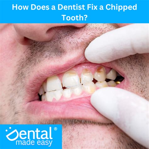 How Does A Dentist Fix A Chipped Tooth Dental Made Easy