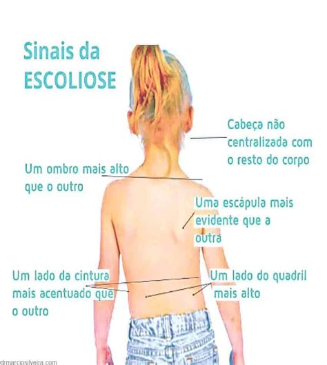 Escoliose Idiop Tica Informa Es Importantes Dr M Rcio Silveira