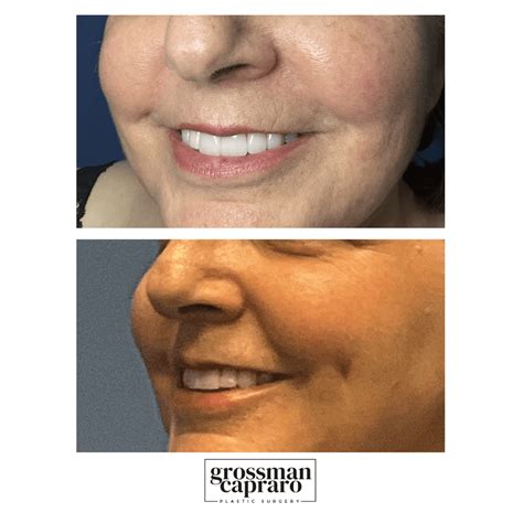 Dimple Creation Grossman Capraro Plastic Surgery