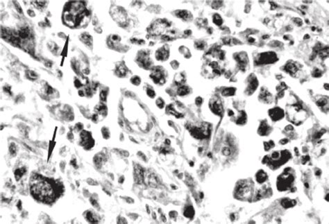 Spleen Pleomorphic Malignant Histiocytes Mixed With Some Lymphocytes