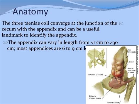 Acute Appendicitis Acute Appendicitis Appendicitis Is Defined As