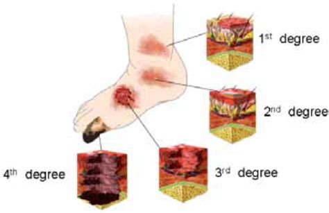 Figure From Topical Antimicrobials For Burn Wound Infections