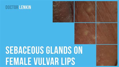 🙁 Sebaceous Glands On Female Vulvar Lips Youtube