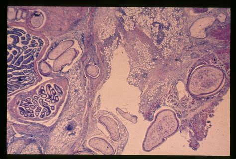 Spirometra Mansonoides Experimental Sparganum Infection In A Rat