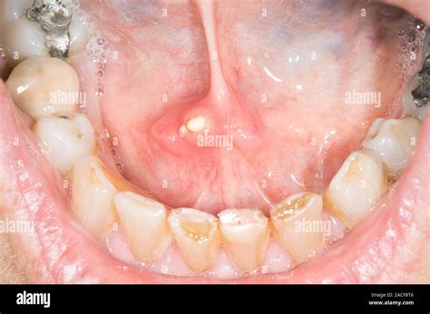 Salivary Duct Calculus Centre White In The Submandibular Salivary