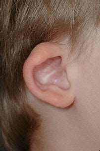 Ear Deformity Correction Uva Facial Plastic Surgery