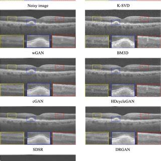 Results Of OCT Images In The First Dataset Using Three Supervised