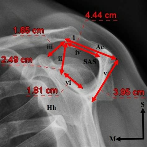 Acromial Types As Proposed By Bigliani Et Al 1986 A Type I Flat