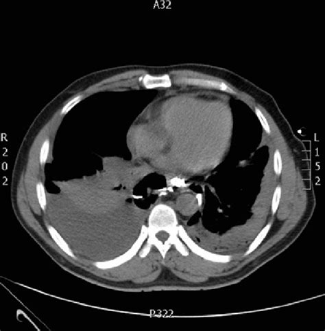 Chest Computed Tomography Scan Showing Bilateral Oral Contrast Download Scientific Diagram