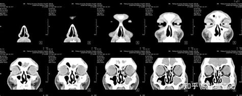 鼻中隔偏曲、鼻窦炎手术及术后恢复记录 知乎
