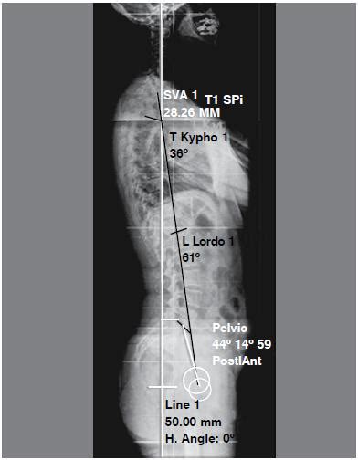 Scielo Brasil Analysis Of Sagittal Balance And Spinopelvic Parameters In A Brazilian