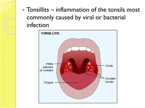 Is Tonsillitis Airborne Is Tonsillitis Contagious Infection