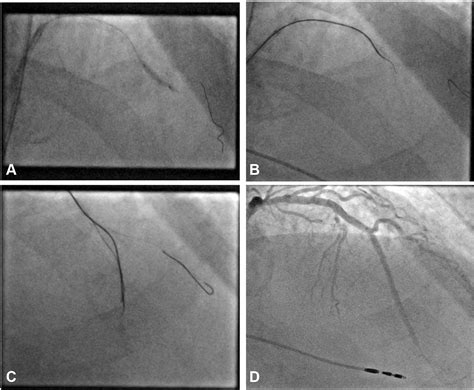 Lithoplasty Facilitated Proximal Cap Penetration Of A Calcified Chronic