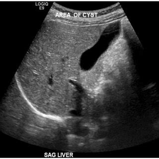 Liver Cyst Ultrasound