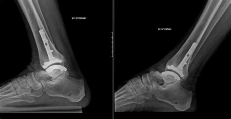 Protesi Di Caviglia Specialista Chirurgia Percutanea Mininvasiva