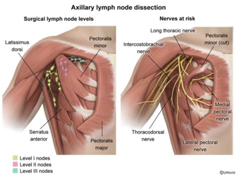 Module 2 Breast Disorders And Breast Cancer Flashcards Quizlet