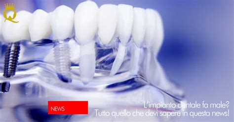 L’impianto dentale fa male? Tutto quello che devi sapere | Dental Q