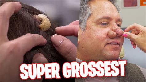 The Grossest And Most Disgusting Moments In Dr Pimple Popper History