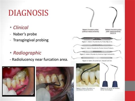 Furcation Involvement Ppt