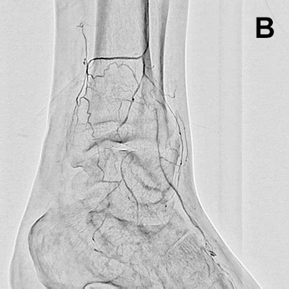 下肢血管腔内治疗方面最大限度地运用Trinias的应用程序 用户体验 Minimally Invasive Experience 岛津医疗