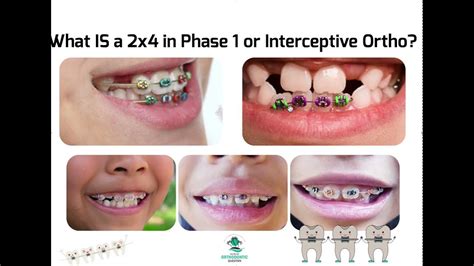 What Is A 2x4 In Interceptive Ortho Phase 1 Braces Explained Youtube