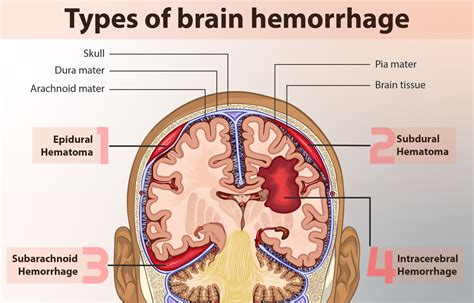 Brain Hemorrhage Treatment – Dr.Samir Parekh