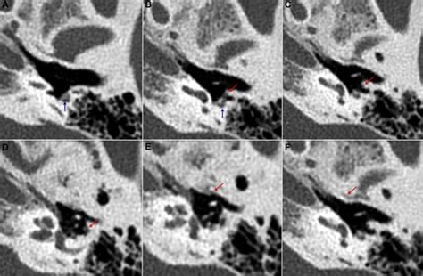 Chorda Tympani Petrotympanic Fissure