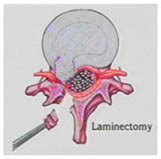 Micro Lumbar Discectomy Surgery India Cost Micro Lumbar Discectomy India